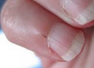 Заусенцы на пальцах: причины и лечение Из за чего появляются заусенцы